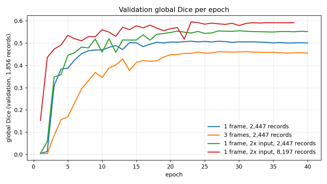 Validation global Dice per epoch for the four runs; the 2x-input run on 8,197 scenes stays highest throughout, the three-frame run lowest.